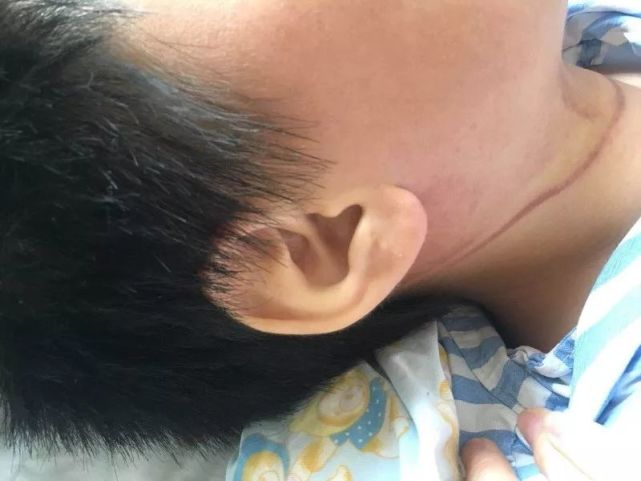 小鵬脖子勒痕示意圖